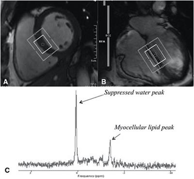 Cardiac Steatosis in HIV-A Marker or Mediator of Disease?